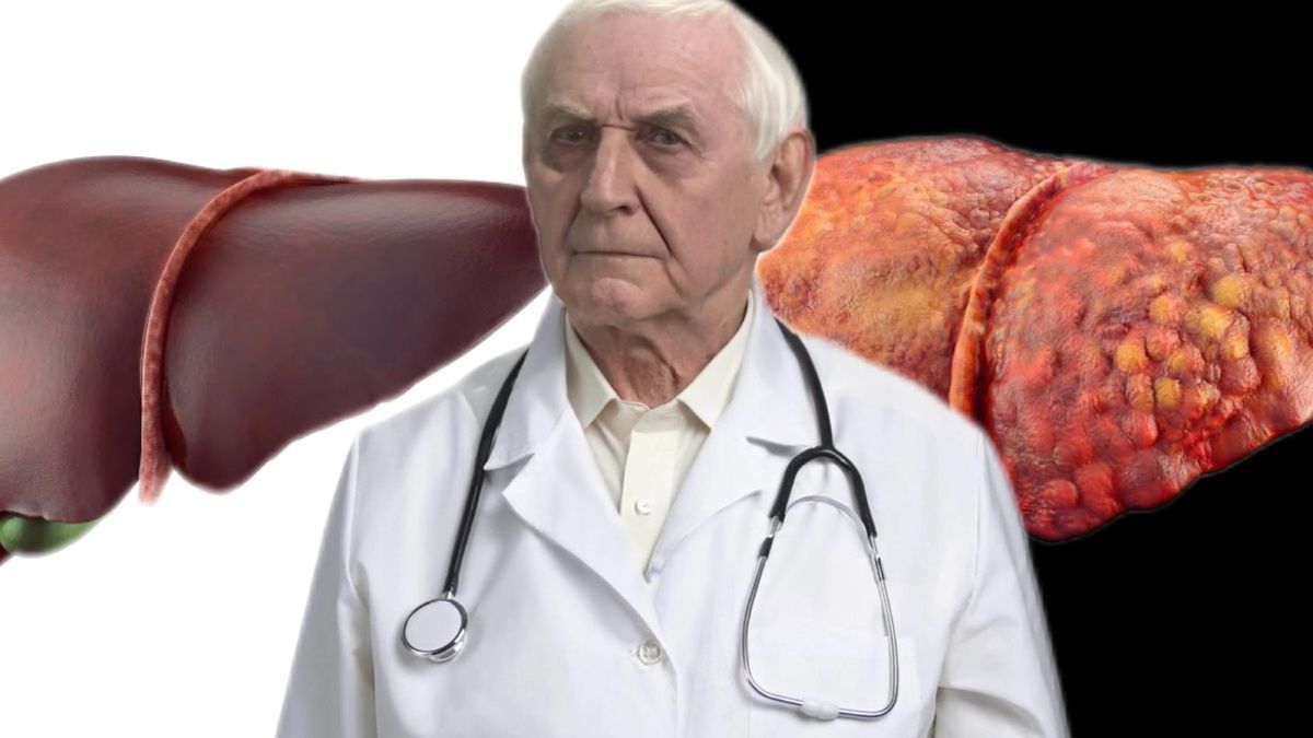 Первый звоночек: 7 признаков, указывающих на цирроз печени